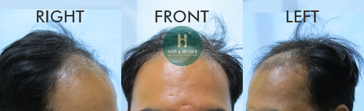 Before Procedure 3500